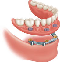 bar-attachment-removable-implant