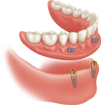 locater-removable-implants